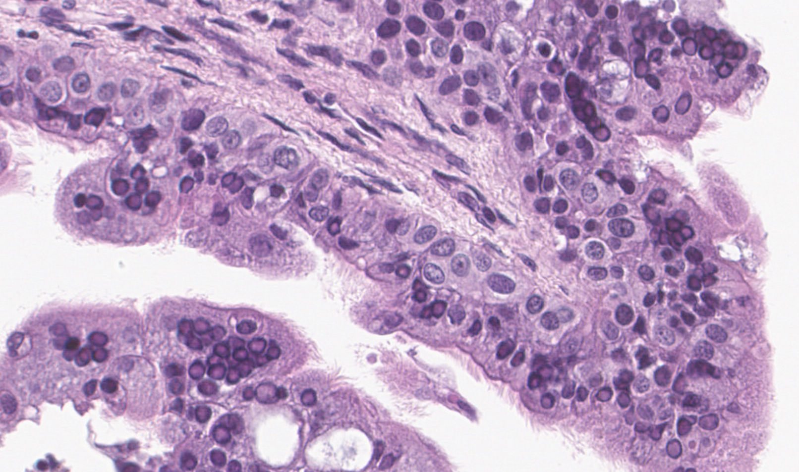 Lung samples showed syncytial giant cells and intranuclear inclusions, both signs of measles infection.