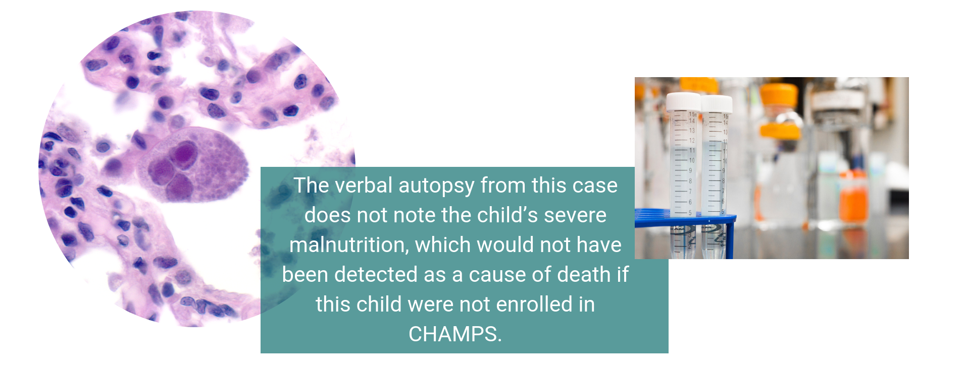 The verbal autopsy from this case does not note the child’s severe malnutrition, which would not have been detected as a cause of death if this child were not enrolled in CHAMPS.