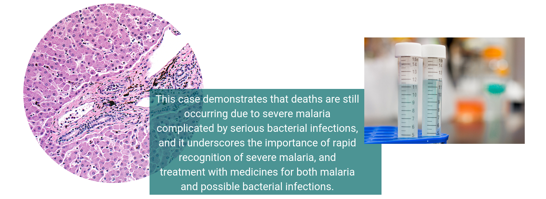 This case demonstrates that deaths are still occurring due to severe malaria complicated by serious bacterial infections, and it underscores the importance of rapid recognition of severe malaria and treatment with medicines for both malaria and possible bacterial infections.