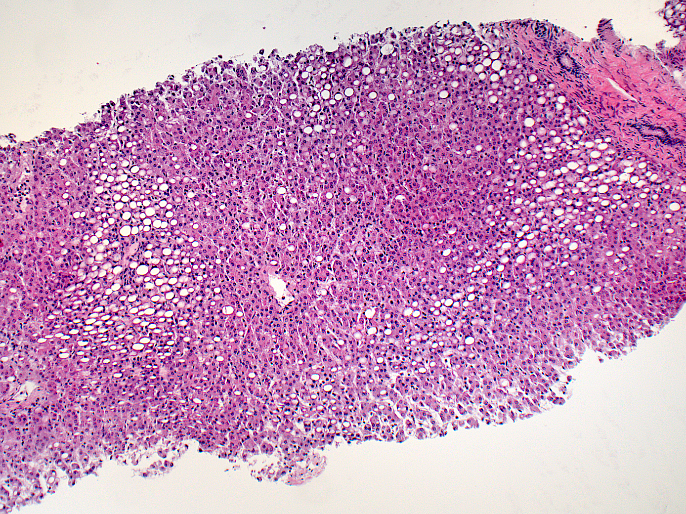 Low magnification of liver with steatosis from malnutrition