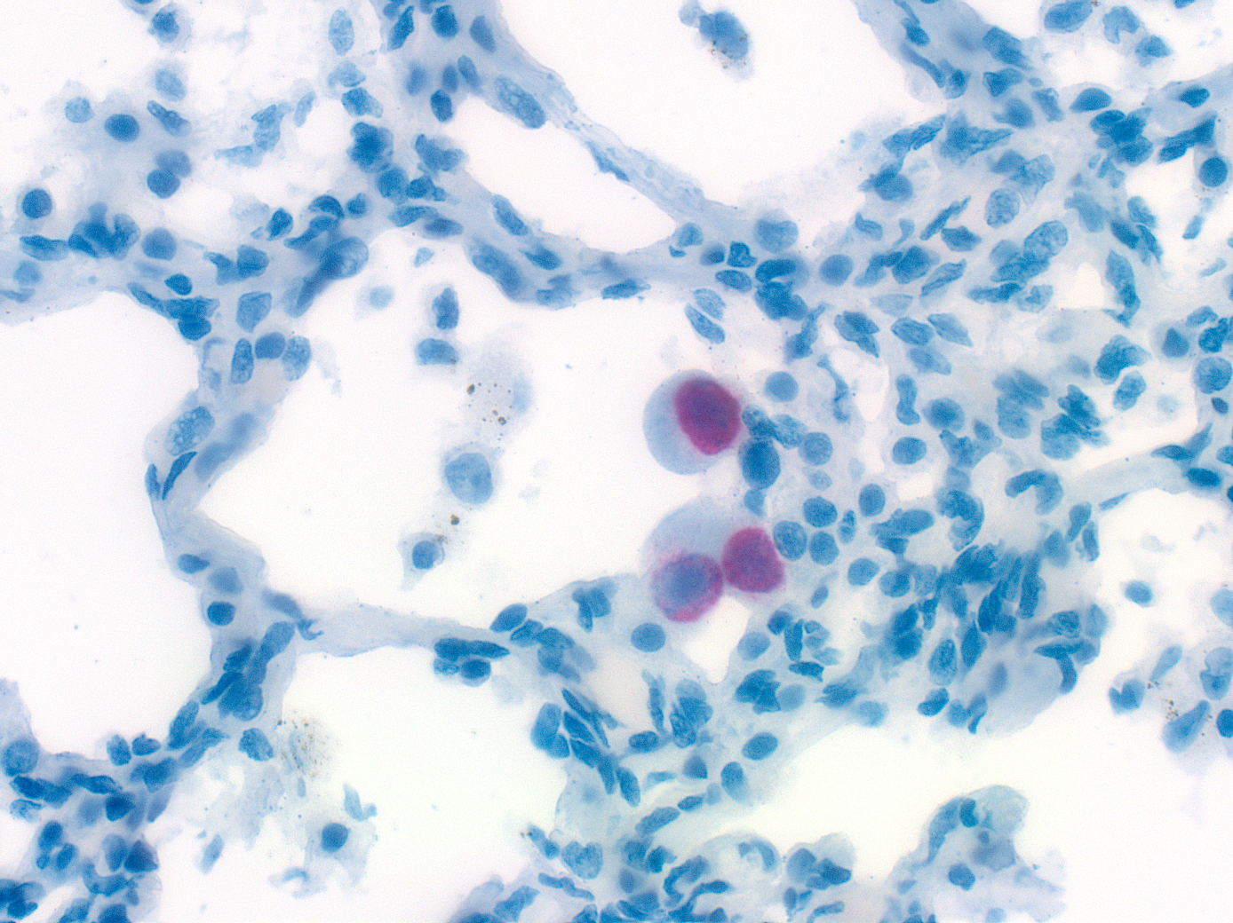 CMV inclusions staining by immunohistochemistry in the lung